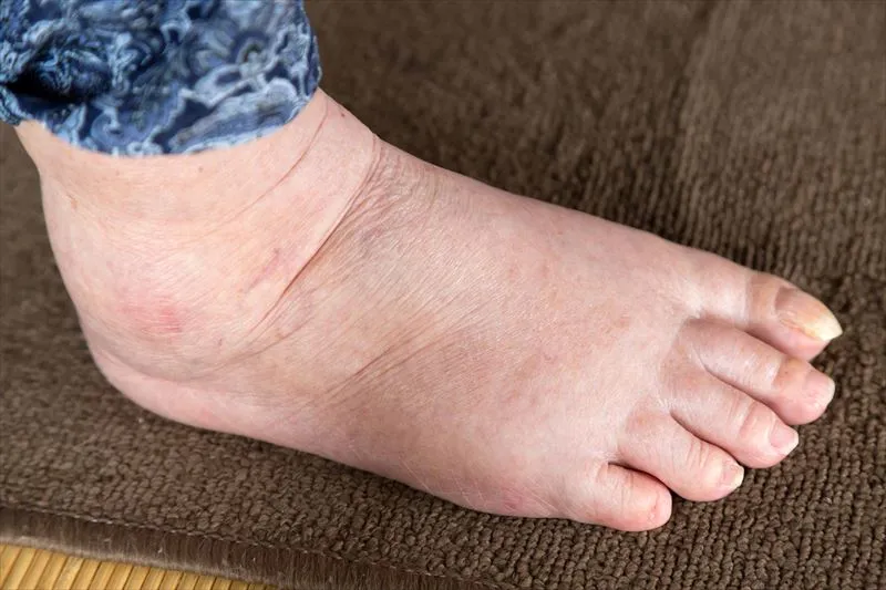 高齢者がむくみやすい原因について